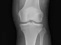 Related: European Joint Reboot Technique